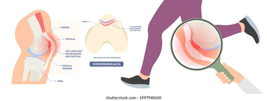 How Patella Straps Can Relieve Patellar Tendonitis Pain
