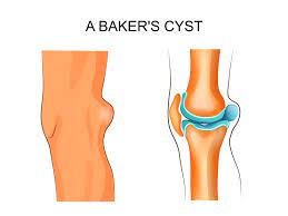What is a Baker's Cyst?