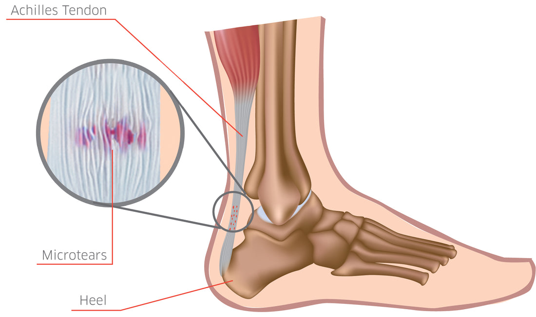 How to Strengthen Your Achilles Tendon