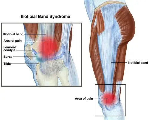 Iliotibial Band Pain and Pain Relief: What You Need to Know