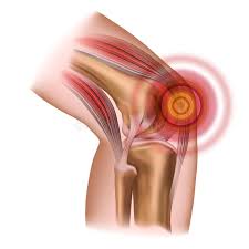 Patellar Tendonitis and Jumper's Knee: Everything You Need to Know