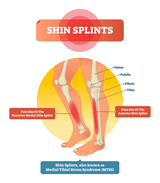 Shin Splints and Their Remedies