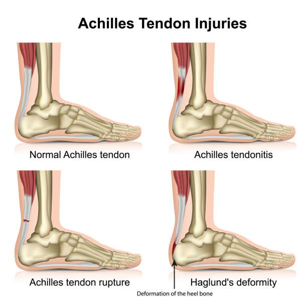 Achilles Tendonitis and Tendinopathy: What's the Difference?